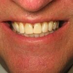 Teeth Whitening Preston
