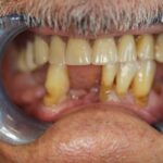 Implants and a Denture Preston